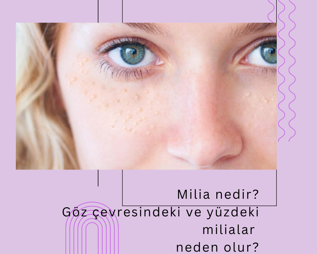 Milia Nedir? Göz Çevresindeki ve Yüzdeki Milialar Neden Olur?