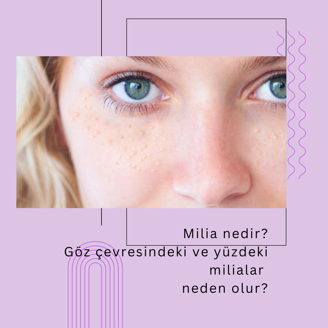 Milia Nedir? Göz Çevresindeki ve Yüzdeki Milialar Neden Olur?