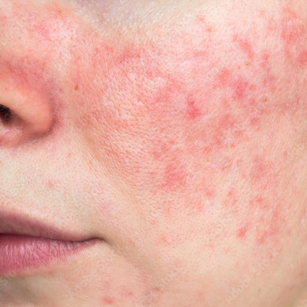 Rosacea