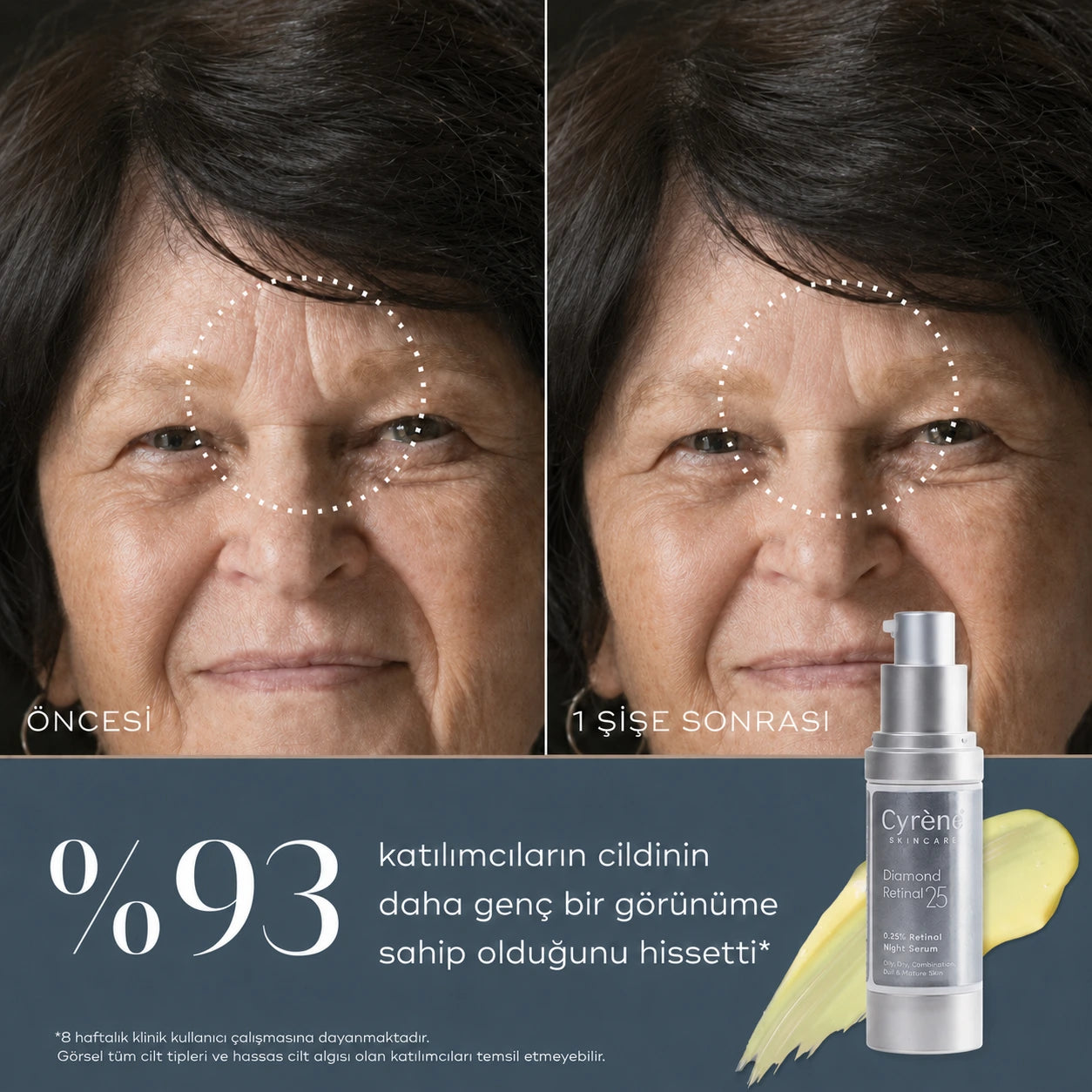 Diamond Retinal 25